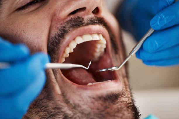 Best Emergency Wisdom Teeth Removal in Fairfax, OK