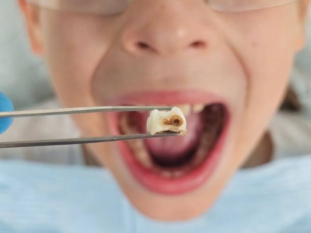 Best Emergency Wisdom Teeth Removal in Fairfax, OK
